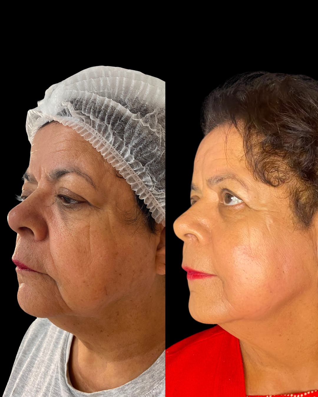 Resultado LANDEface antes e depois em perfil lateral