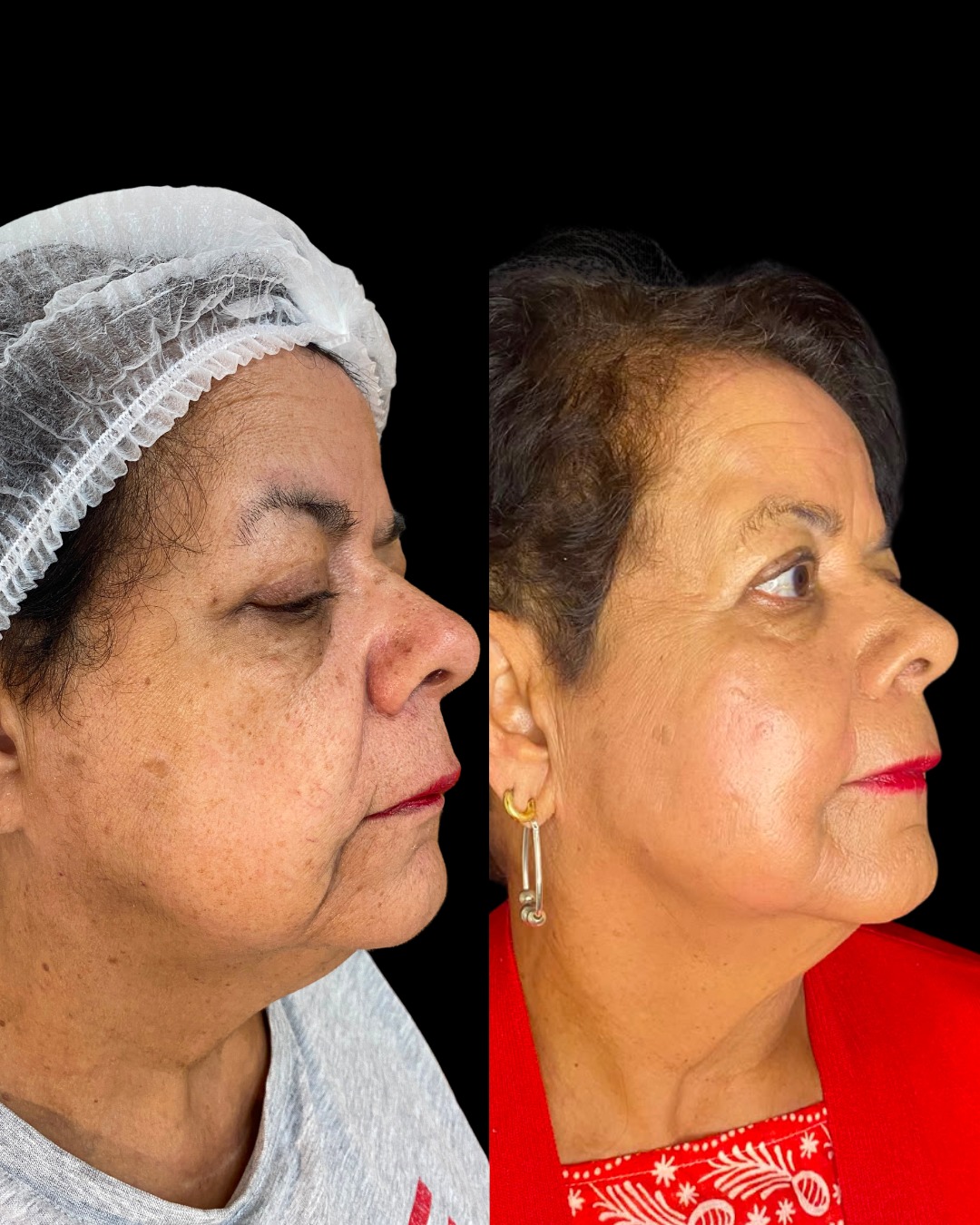 Resultado LANDEface antes e depois em outro perfil lateral