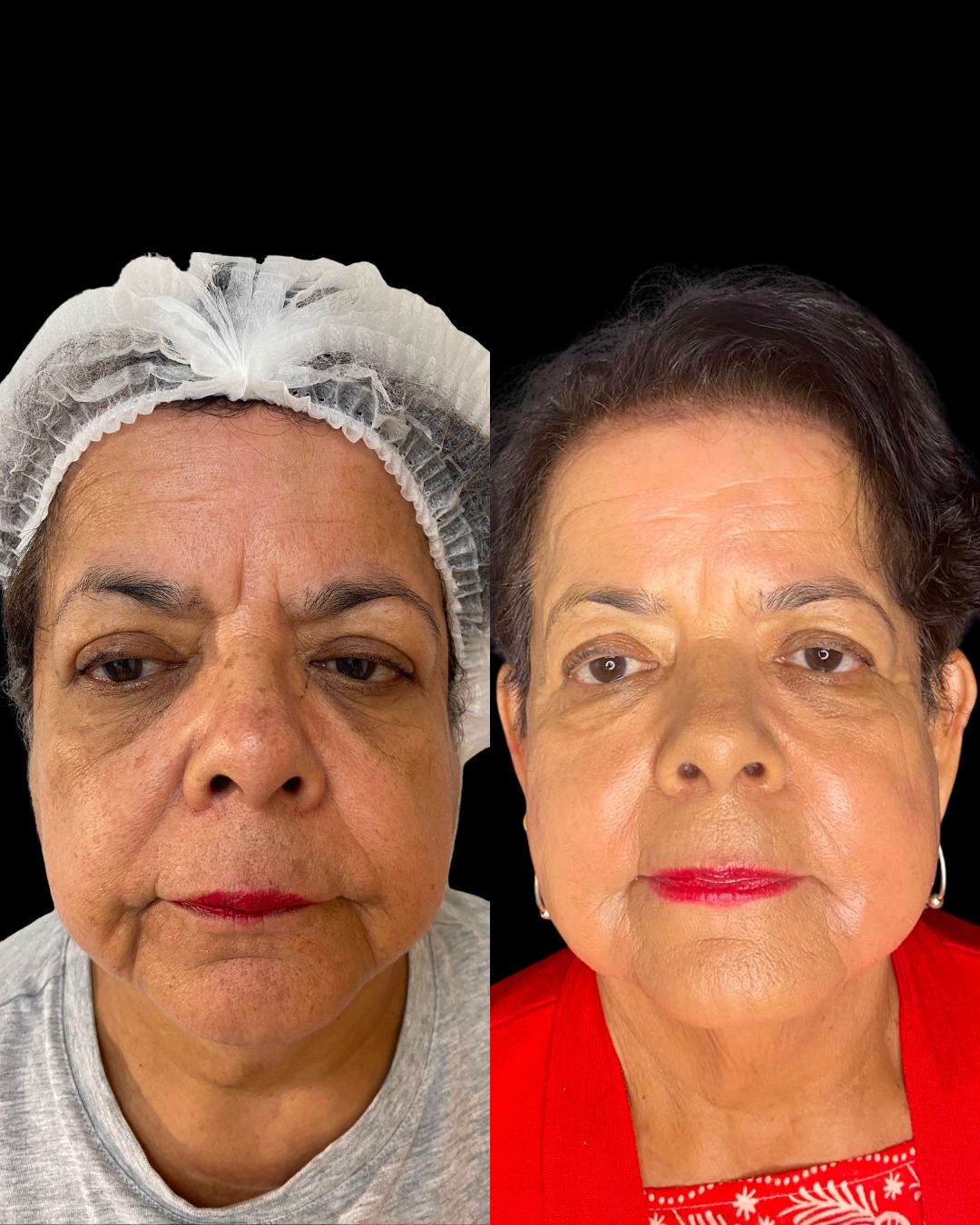 Resultado LANDEface antes e depois em vista frontal