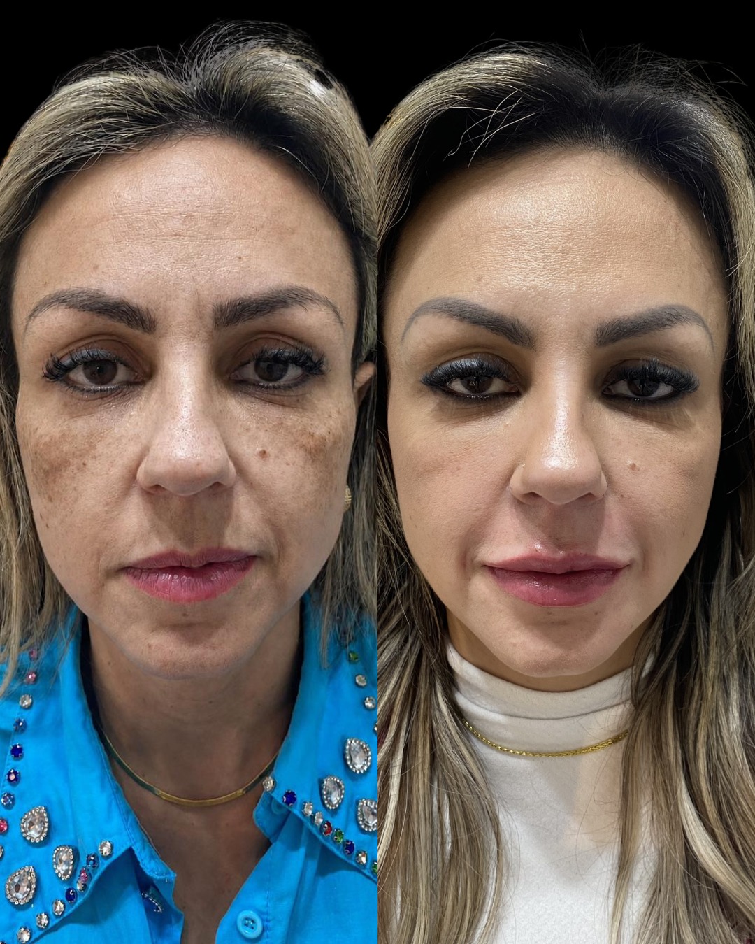 Resultado LANDEface antes e depois frontal