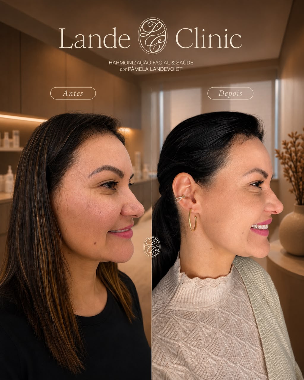 Resultado LANDEface antes e depois em perfil