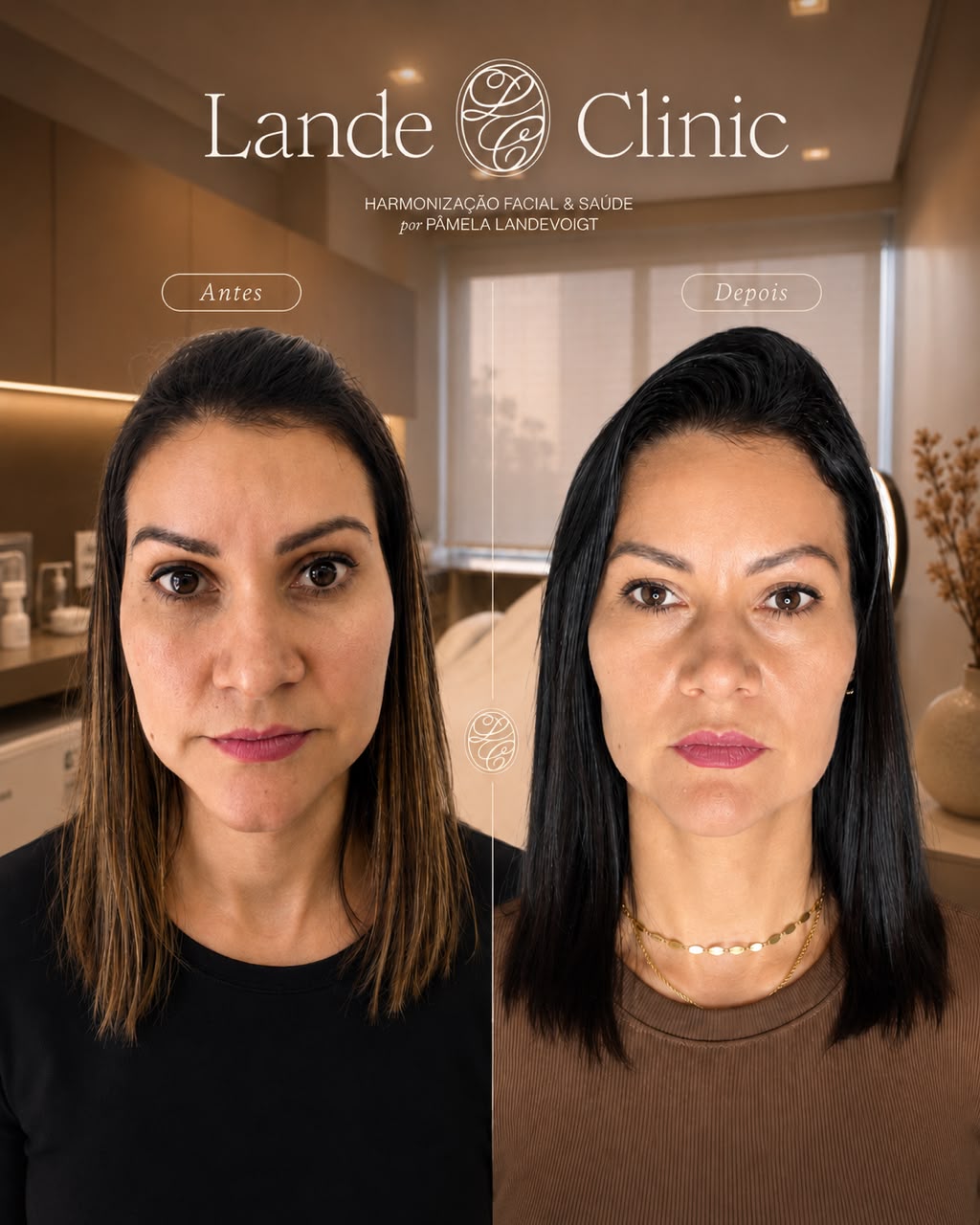 Resultado LANDEface antes e depois em vista frontal