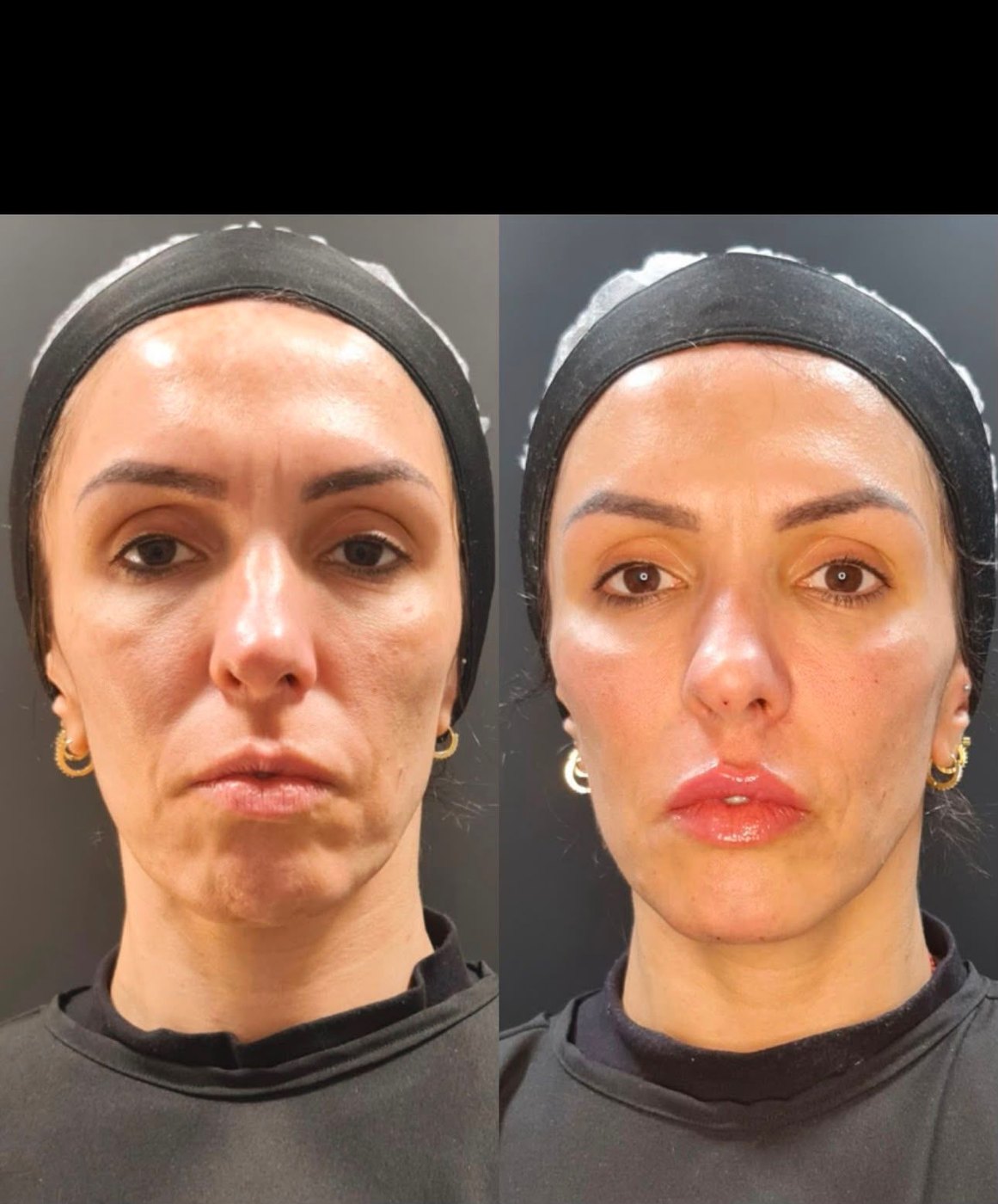 Resultado LANDEface antes e depois em vista frontal